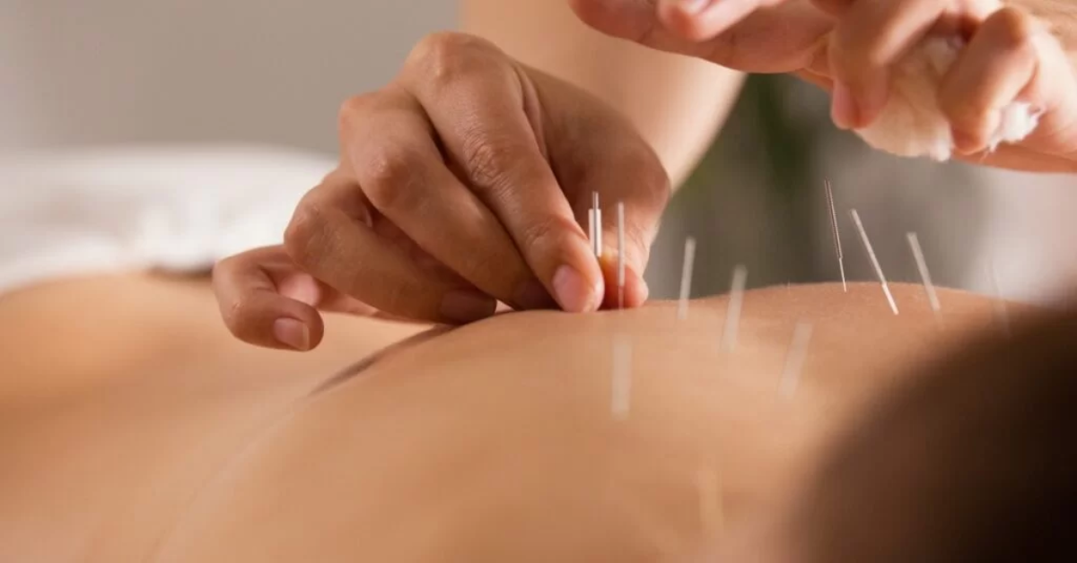 Best Acupuncture Singapore